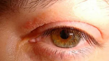 Allergy на клепачите и лечение на очите причинява, мазила, капки, подуване, подуване, червено