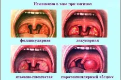 Angina Simanovsky Vincent (ulcer)