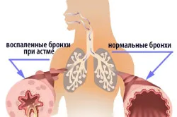 Asztmás hörghurut gyermekek tünetei és kezelése