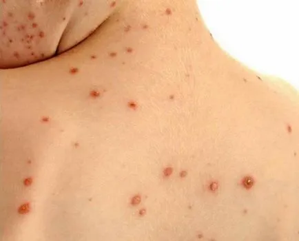 Az atópiás dermatitis gyermekeknél (fotók) - Tünetek és kezelés