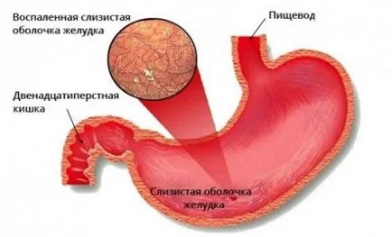 Ahilichesky gyomorhurut tünetei, kezelése, diéta