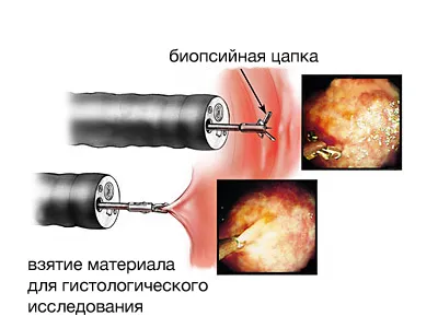 А биопсия по време на колоноскопия