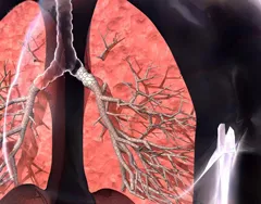 Bronchitis kezelés hosszú