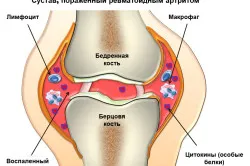 Болка в петата причини