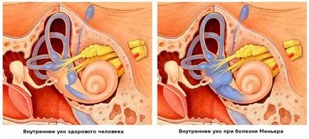 , Лечение на Мениер симптоми на заболяването