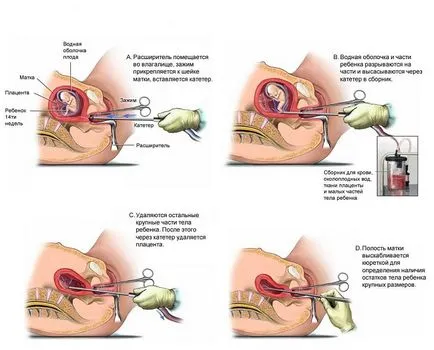 Gyomorfájás után abortusz - változatai norma és patológia videó