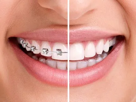 Központi Dental Braces Cseljabinszk