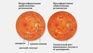 Какво е - пролиферативни и не-пролиферативна диабетна ретинопатия причини, симптоми и