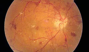 Какво е - пролиферативни и не-пролиферативна диабетна ретинопатия причини, симптоми и