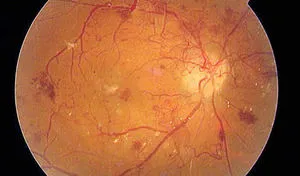 Ce este - proliferative și non-proliferative retinopatie diabetică cauze, simptome si