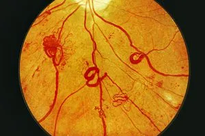 Ce este - proliferative și non-proliferative retinopatie diabetică cauze, simptome si