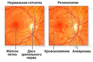 Ce este - proliferative și non-proliferative retinopatie diabetică cauze, simptome si