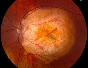 Mi ez - proliferatív és nem-proliferatív diabetikus retinopátia okok, tünetek és