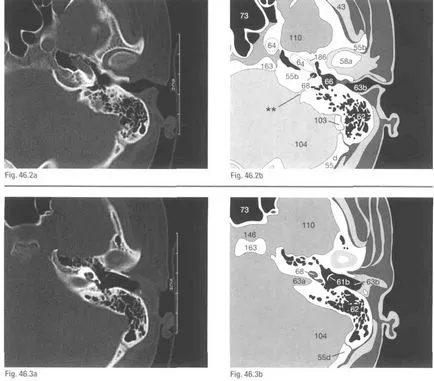 Mit jelent az MRI és CT kontrasztanyaggal vagy a belső fül