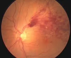 Mi retina-trombózis