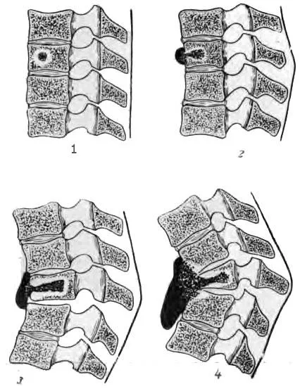 Унищожаване и деформация на гръбначния стълб - патогенезата и патоанатомия - TB