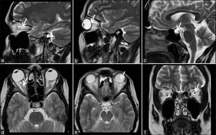 Diagnostics MRI a belső fül