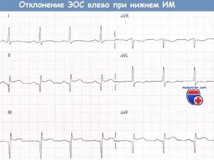 EKG blokád elülső ága bal szárblokk (lnpg)