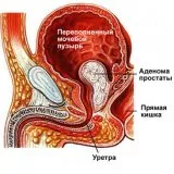 Алтернативно лечение на простатит - скалпел - медицинска информация и образование