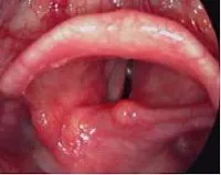 pareza neuropatice a laringelui - cauze, simptome, diagnostic și tratament