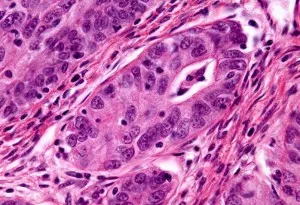 Endometrioid adenokarcinóma jobb megelőzése