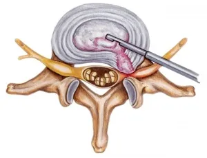 Ендоскопска операция на гръбначния стълб за отстраняване на херния, ендоскопско лечение на дискова херния
