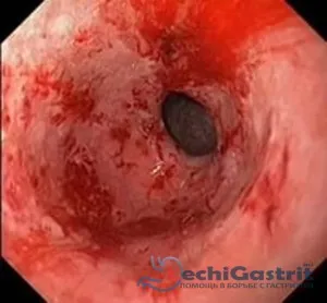 Erodarea stomacului tratate cu medicamente si terapie dieta