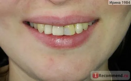 Cosmetic Stomatologie - restaurare arta de dinți - „Acum vreau să zâmbesc mereu! 