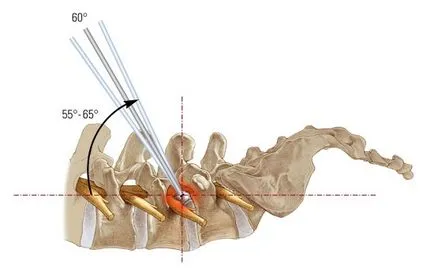 chirurgie a coloanei vertebrale endoscopica pentru a elimina o hernie, un tratament endoscopic pentru hernie de disc