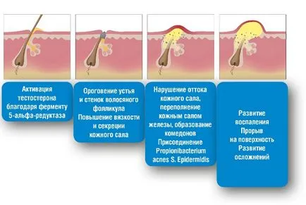 Befolyásoló tényezők faggyúmirigy és a pattanások fejlesztés