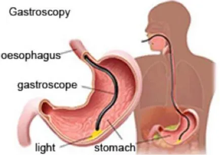 EGD (gastroscopie) pregătirea procedurii, indicații și contraindicații