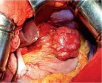 Stromale gastro-intestinale tumora - cauze, simptome, diagnostic și tratament