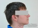 Overbite - fogszabályozó kezelés a serdülő - Igor tonna, 13 éves