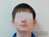 Overbite - fogszabályozó kezelés a serdülő - Igor tonna, 13 éves