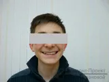 Overbite - fogszabályozó kezelés a serdülő - Igor tonna, 13 éves