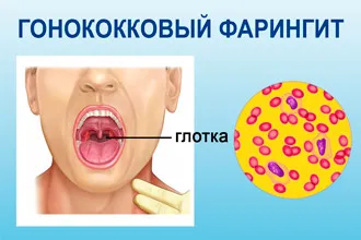 Gonococi (gonorrheal) faringita - Simptome si tratament