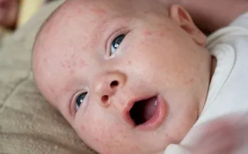 Гнойни пъпки по лицето и тялото на новороденото - причините за това състояние на опасност, възможността за