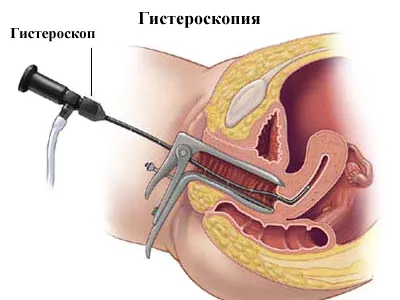 Хистероскопия ефекти и възможни усложнения