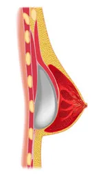 Az implantátum izom alatti mellnagyobbítás műtét különösen