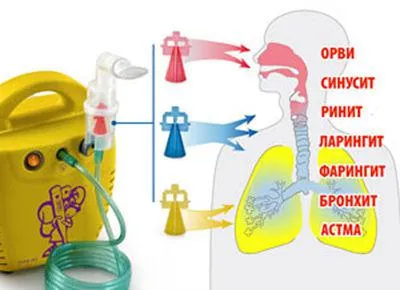 Ларингит инхалационни лекарства пулверизатори за деца и възрастни