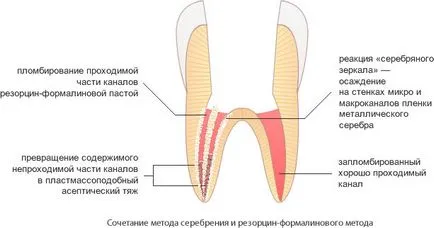 Metode Impregnatsionnye de tratare a articolelor de conținut de canal despre stomatologie