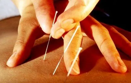 Acupunctura și contraindicații