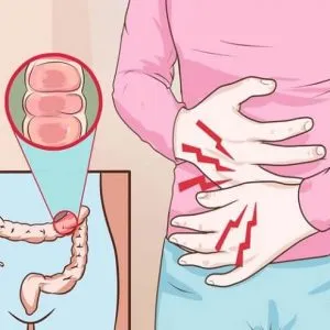 Ischaemiás colitis bél - tünetei, diagnózisa, kezelése és megelőzése