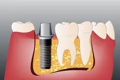 implanturi dinți israelieni, implanturi dentare din Israel - Preturi si tipuri