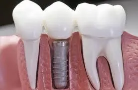 Израелски импланти зъби, зъбни импланти в Израел - Цени и видове