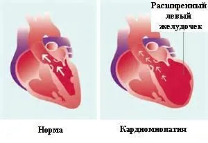 Cum alcoolul afecteaza inima, recomandarile medicilor pentru boli cardiace