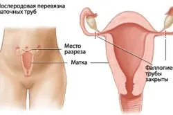 Какви могат да бъдат последствията, ако да завърже на фалопиевите тръби