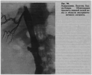 Boli ale vaselor de ficat - experți în medicină