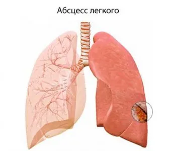 Bronșiectazie simptome pulmonare si tratament, cauze, complicații