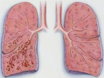 Bronșiectazie simptome pulmonare si tratament, cauze, complicații